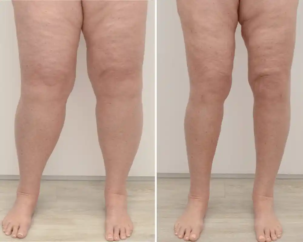 Avant / après : jambes dégonflées après utilisation de LymphoBlast